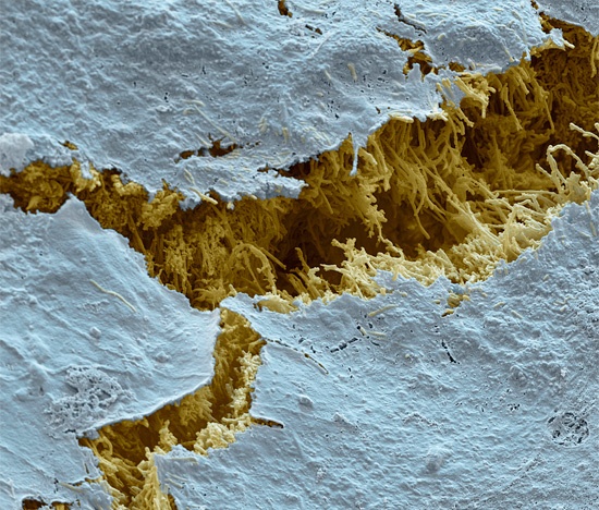 Кариес, электронная микроскопия