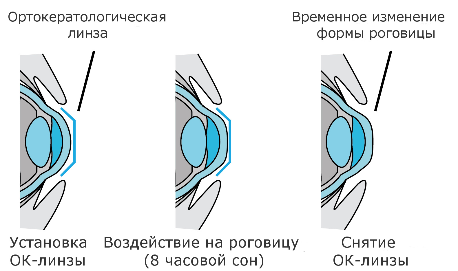 Ночные контактные линзы для тех, кто не носит очки, но боится при этом коррекции - 2