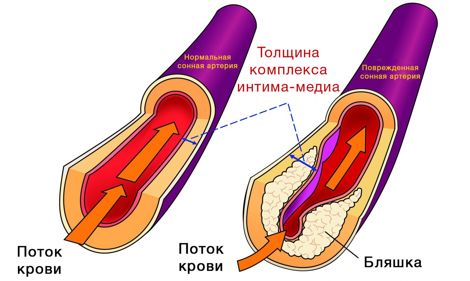 Что такое утолщение комплекса интима Медиа