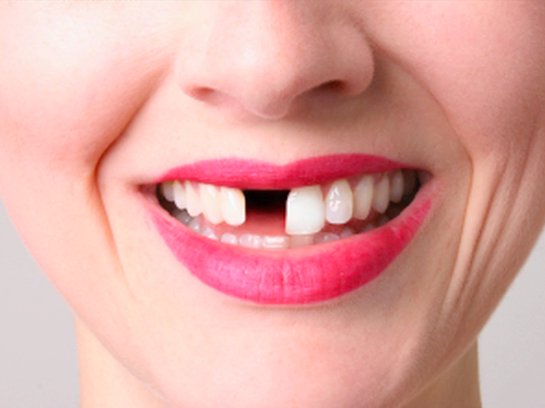 Ученые рассказали, какие продукты портят зубы