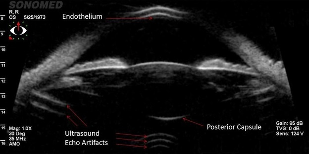 Пресбиопия: «климакс» глаз у мужчин и женщин - 4 Пресбиопия: «климакс» глаз у мужчин и женщин - 4