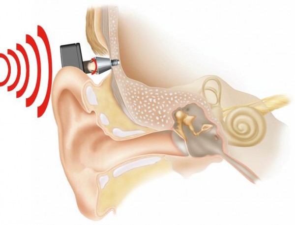 ADHEAR — еще один безопасный слуховой аппарат на базе костной проводимости звука - 2