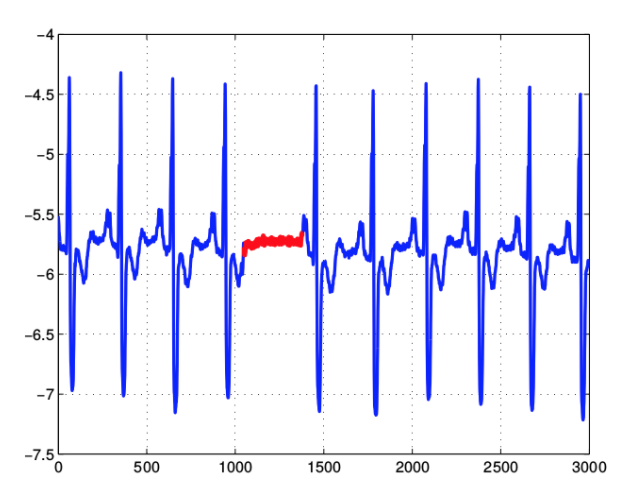 Кибер-оракул: поиск аномалий в данных мониторинга с помощью нейросети - 4 Рис. 2. Аномалия на кардиограмме