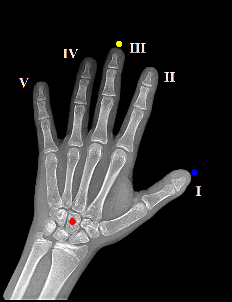 Pediatric Bone Age Challenge. Deep Learning и много, много костей - 5