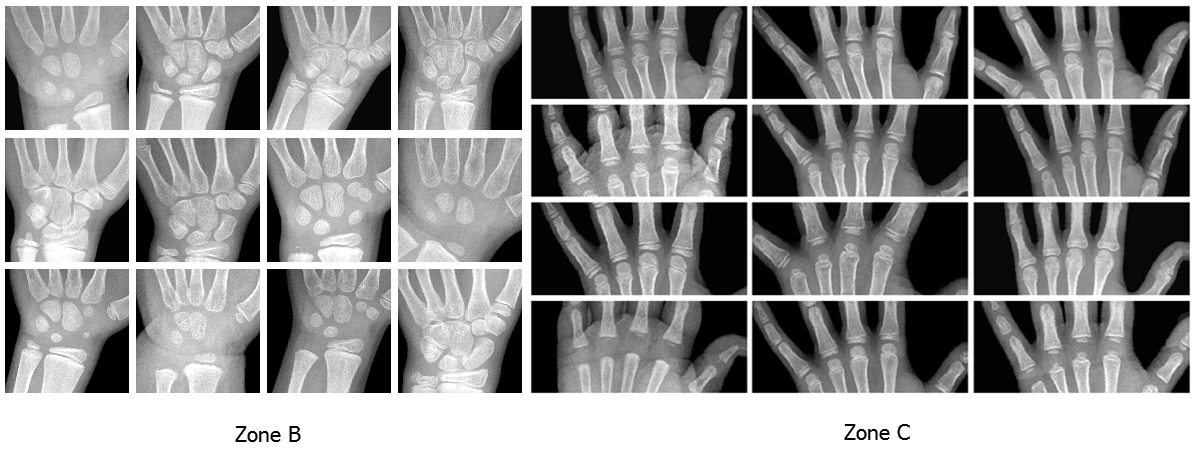 Pediatric Bone Age Challenge. Deep Learning и много, много костей - 8