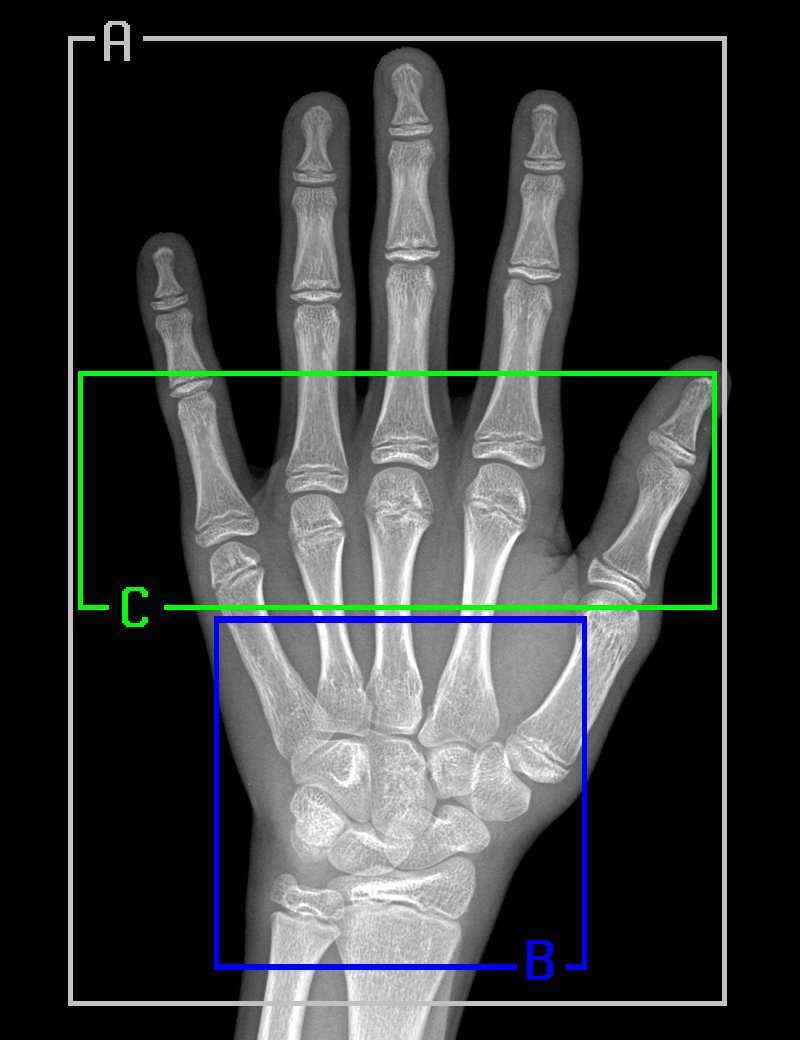 Pediatric Bone Age Challenge. Deep Learning и много, много костей - 9