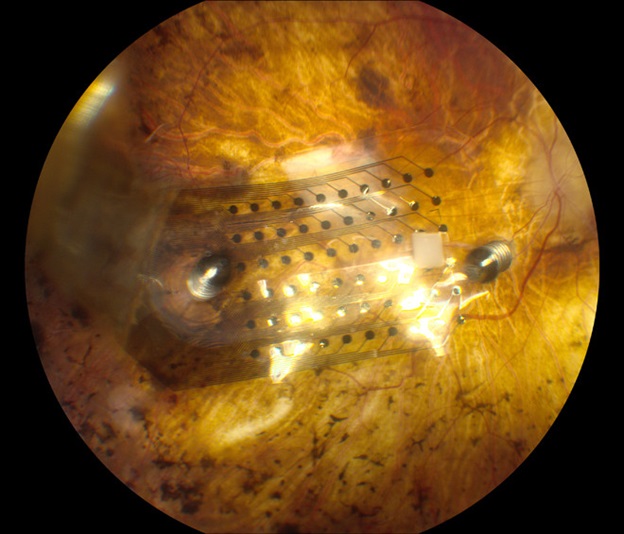 Протезирование сетчатки глаза