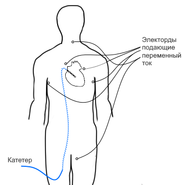 Квест по устранению аритмии сердца - 3 image
