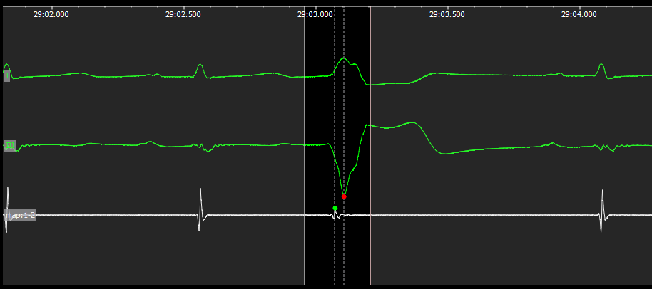 Квест по устранению аритмии сердца - 8 image