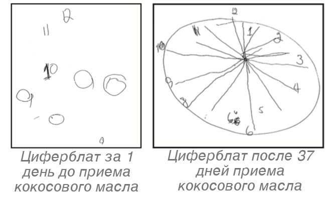 Диабет, деменция и даже мигрени. Кетогенная диета оказывается эффективнее лекарств - 4