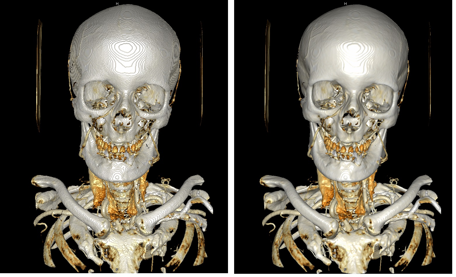 Сегментация томографических данных - 12 Сегментация томографических данных - 12