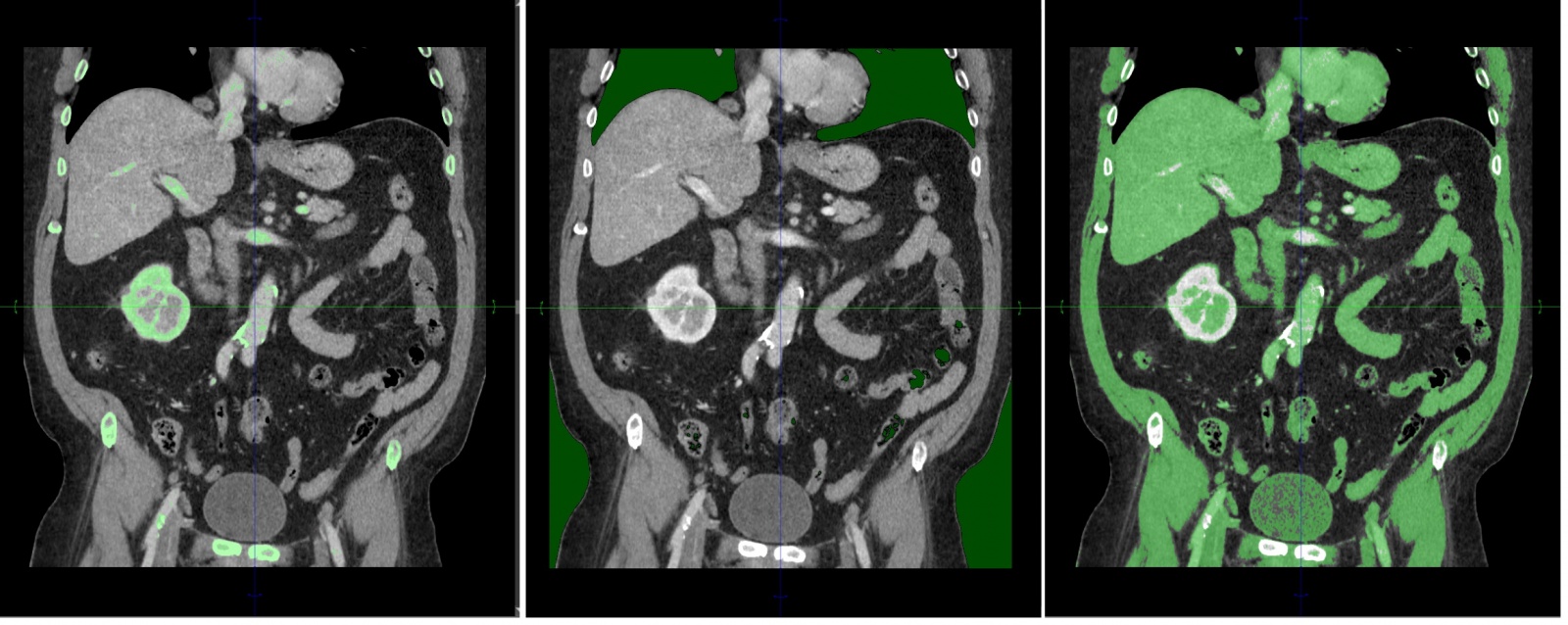 Сегментация томографических данных - 17
