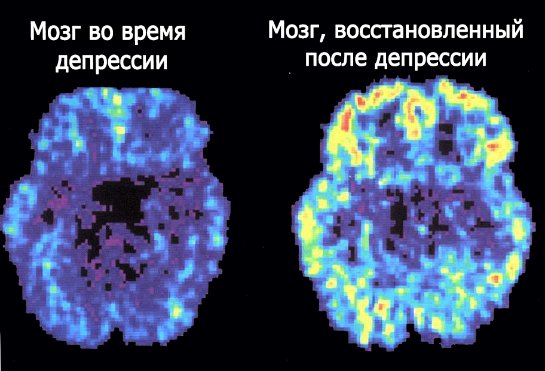 Из-за депрессии мозг старее быстрее