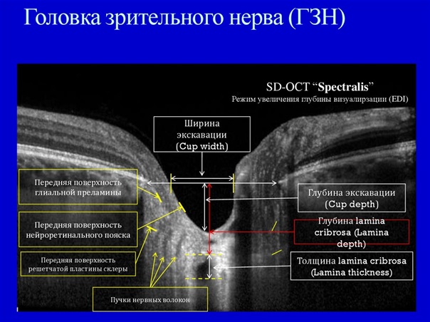 Головка зрительного нерва при глаукоме