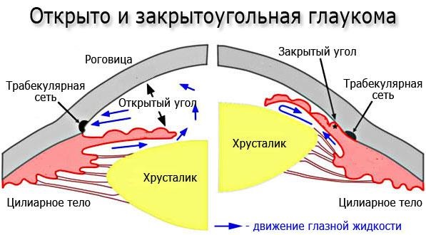 Открыто и закрытоугольная глаукома