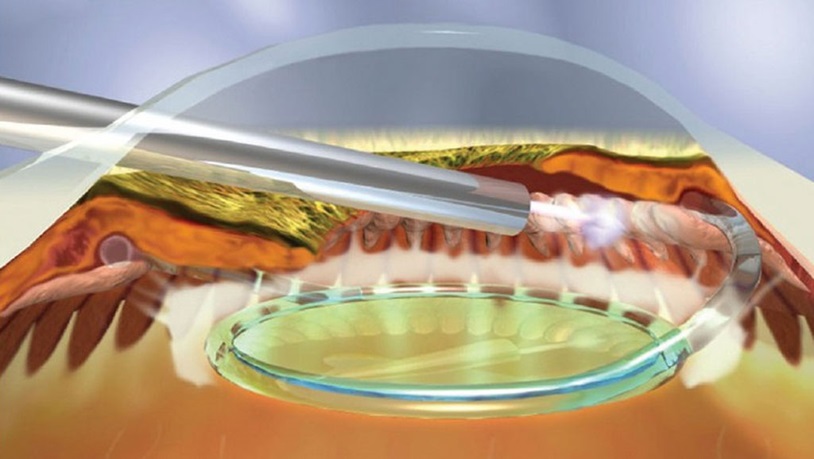 эндоскопическая циклофотокоагуляция в лечении глаукомы