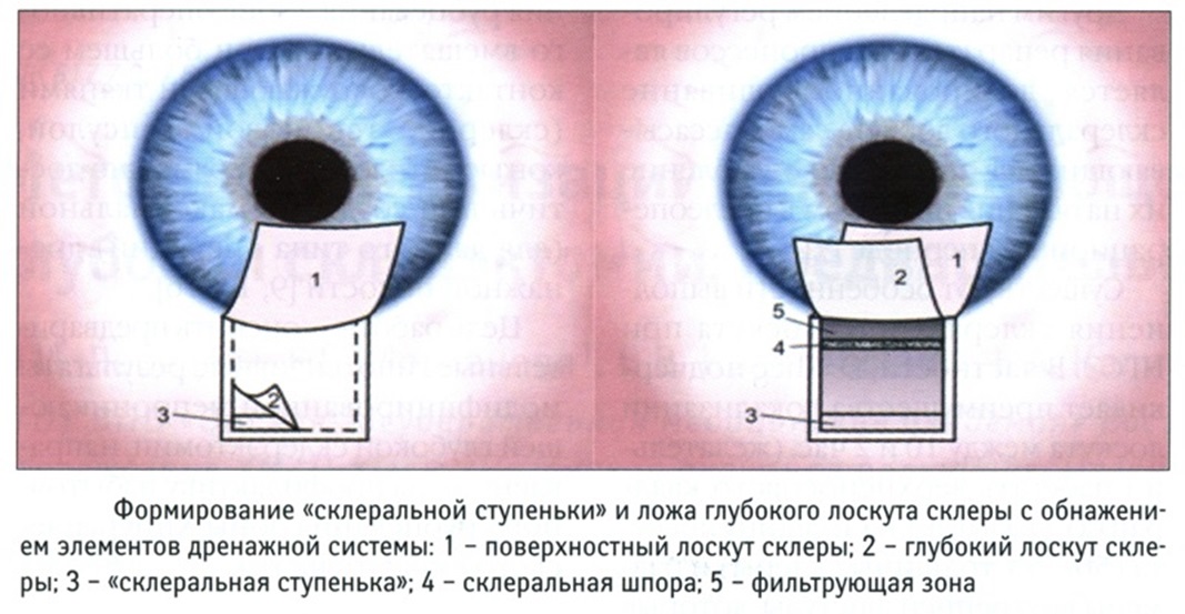 непроникающая глубокая склерэктомия (НГСЭ) при глаукоме