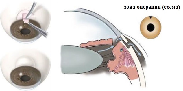 Операция трабекулоэктомии при глаукоме