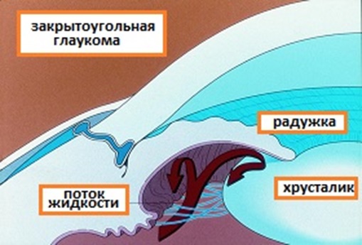 лазерное лечение глаукомы