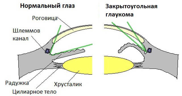 лазерные методы при глаукоме