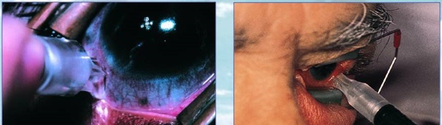 Наружная циклофотокоагуляция (ЦФК) при глаукоме