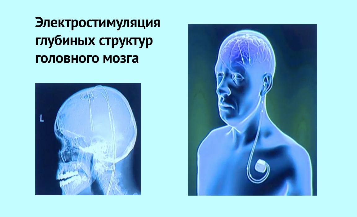 Остров киборгов: начинаем разработку инвазивной микроэлектроники - 3 image