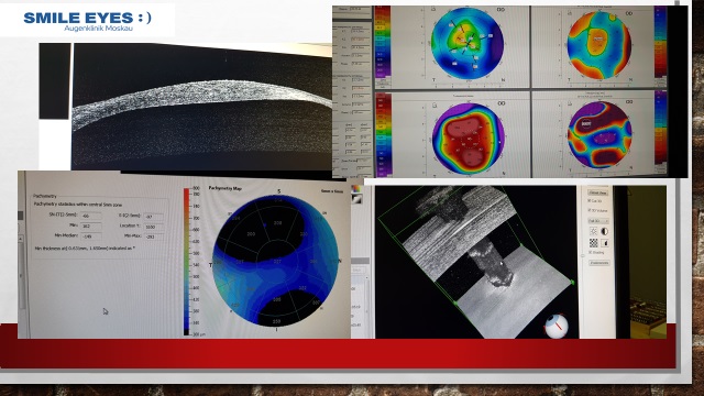 Топограмма роговицы глаза после некскольких рефракционных операций