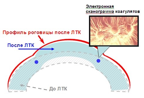 Термокератопластика