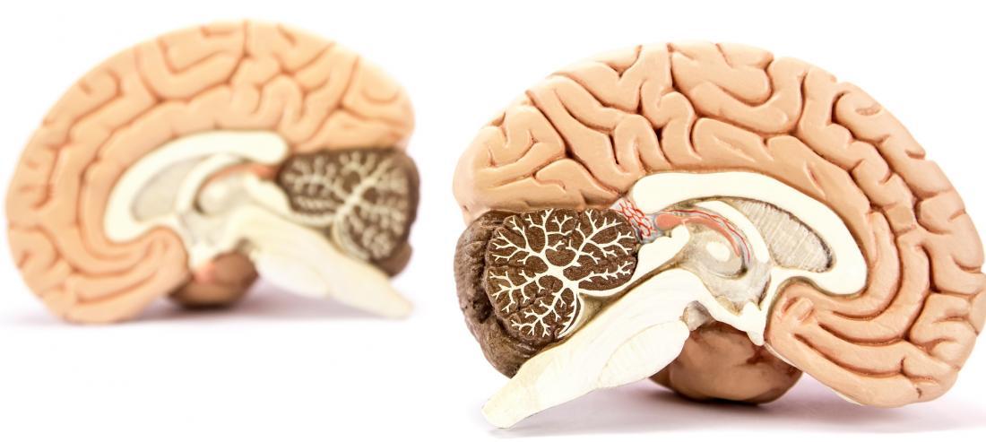 Split brain. Вентрикулоперитонеальное шунтирование фото. Split my Brains.