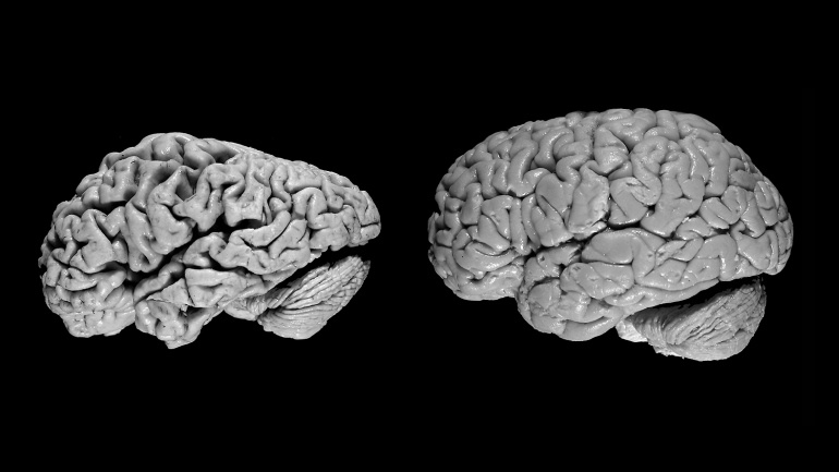 Искусственный интеллект научился находить болезнь Альцгеймера в мозге за 6 лет до диагноза - 2