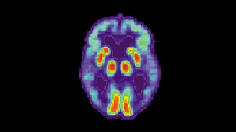 Искусственный интеллект научился находить болезнь Альцгеймера в мозге за 6 лет до диагноза - 1