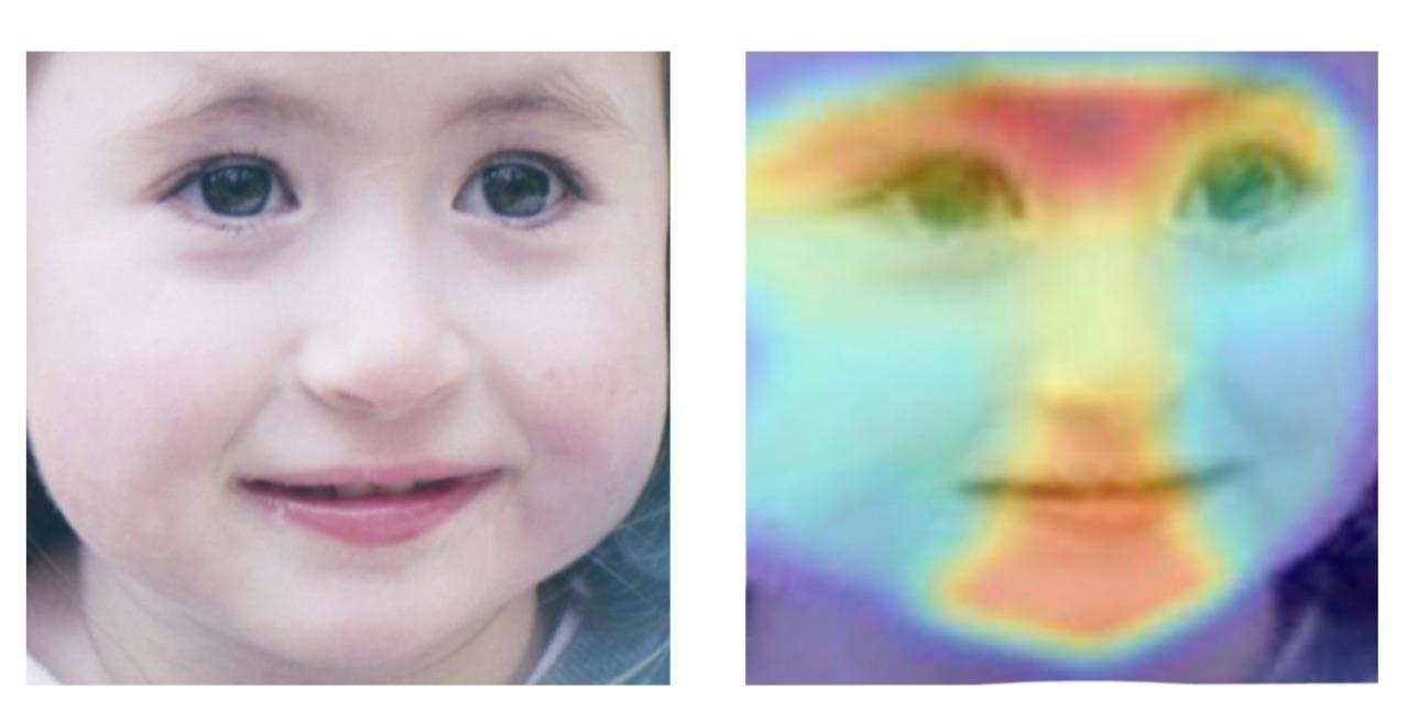 Нейросеть обучили идентифицировать редкие наследственные заболевания по фотографии человека - 2 Нейросеть обучили идентифицировать редкие наследственные заболевания по фотографии человека - 2