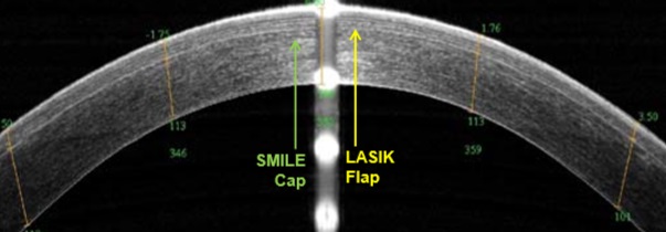 Крышка в роговицы после ReLEx SMILE