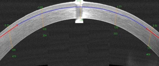 Топограмма роговицы после докоррекции после ReLEx SMILE методом CIRCLE