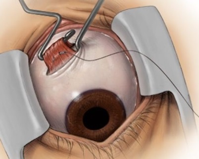Хирургическое исправление косоглазия