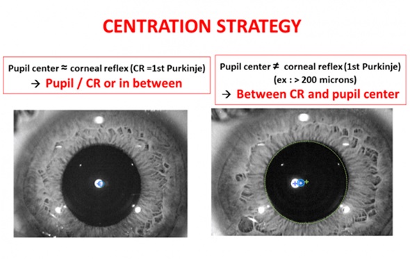 Центрация во время лазерной коррекции зрения
