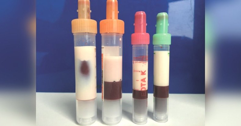 Избыток жира превратил кровь больного в бледное «молоко» Избыток жира превратил кровь больного в бледное «молоко»