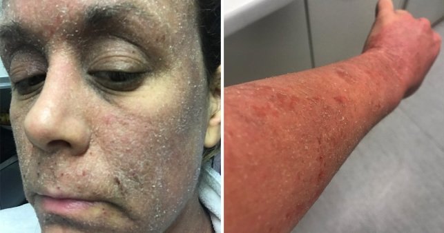 Зависимость от крема для кожи превратила женщину в «зомби»