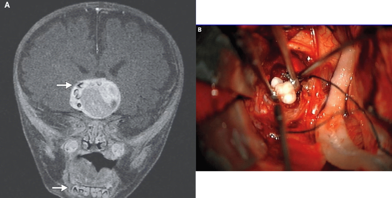 Из мозга младенца извлекли взрослые зубы
