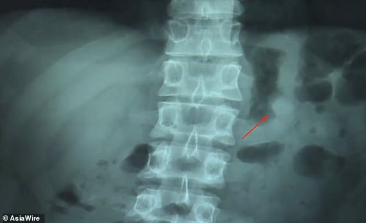 Наушник Apple AirPods продолжил работать, побывав в желудке человека Наушник Apple AirPods продолжил работать, побывав в желудке человека