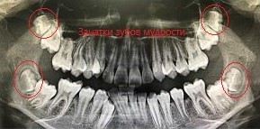 Зубы мудрости: Тянем-потянем - 6 image