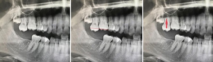 Зубы мудрости: Тянем-потянем - 8 image