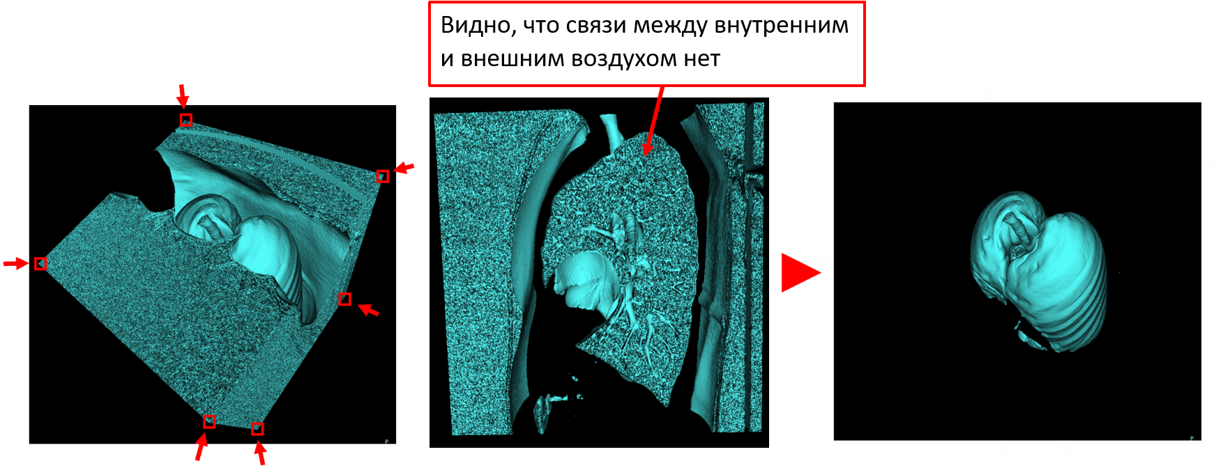 Автоматическая сегментация дыхательных органов - 11