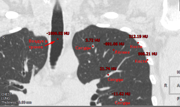 Автоматическая сегментация дыхательных органов - 5
