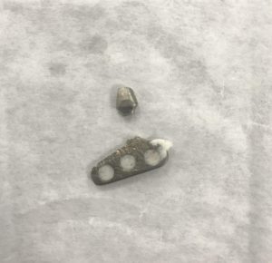 Имплантация при полном отсутствии зубов, как следствие несвоевременного обращения к стоматологу - 12 image