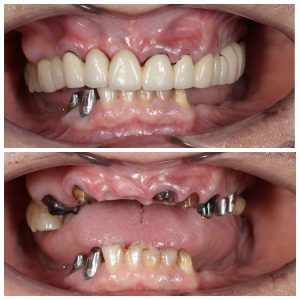 Имплантация при полном отсутствии зубов, как следствие несвоевременного обращения к стоматологу - 2 image