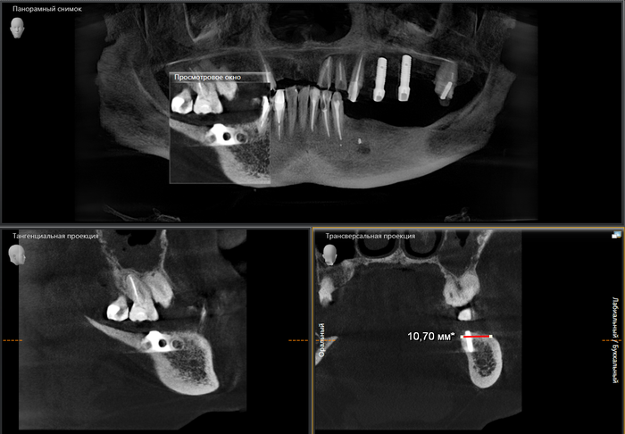 Имплантация при полном отсутствии зубов, как следствие несвоевременного обращения к стоматологу - 3 image