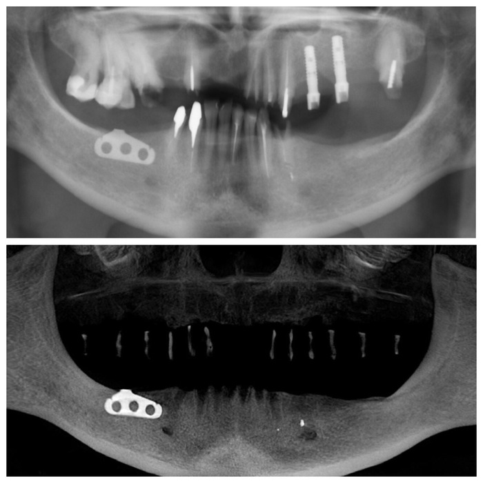 Имплантация при полном отсутствии зубов, как следствие несвоевременного обращения к стоматологу - 7 image