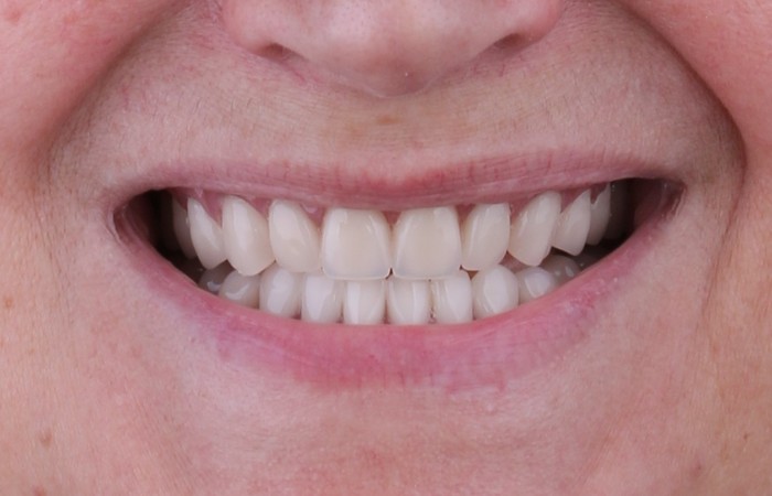 Имплантация при полном отсутствии зубов, как следствие несвоевременного обращения к стоматологу - 8 image