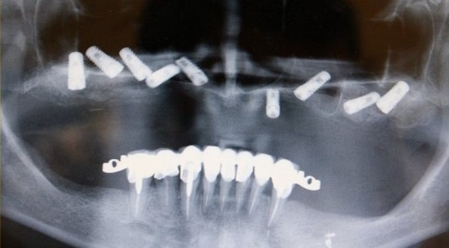 Имплантация при полном отсутствии зубов, как следствие несвоевременного обращения к стоматологу - 9 image